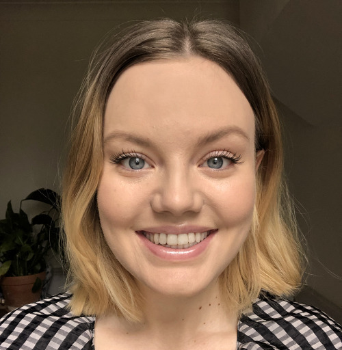Résultat après traitement Invisalign